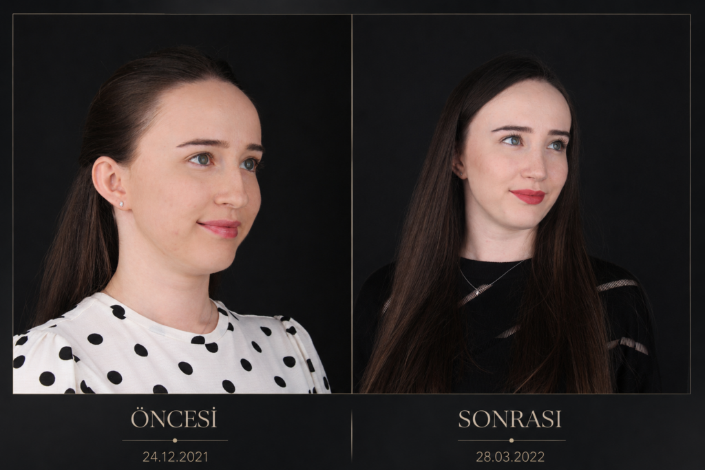 Öncesi / Sonrası 1