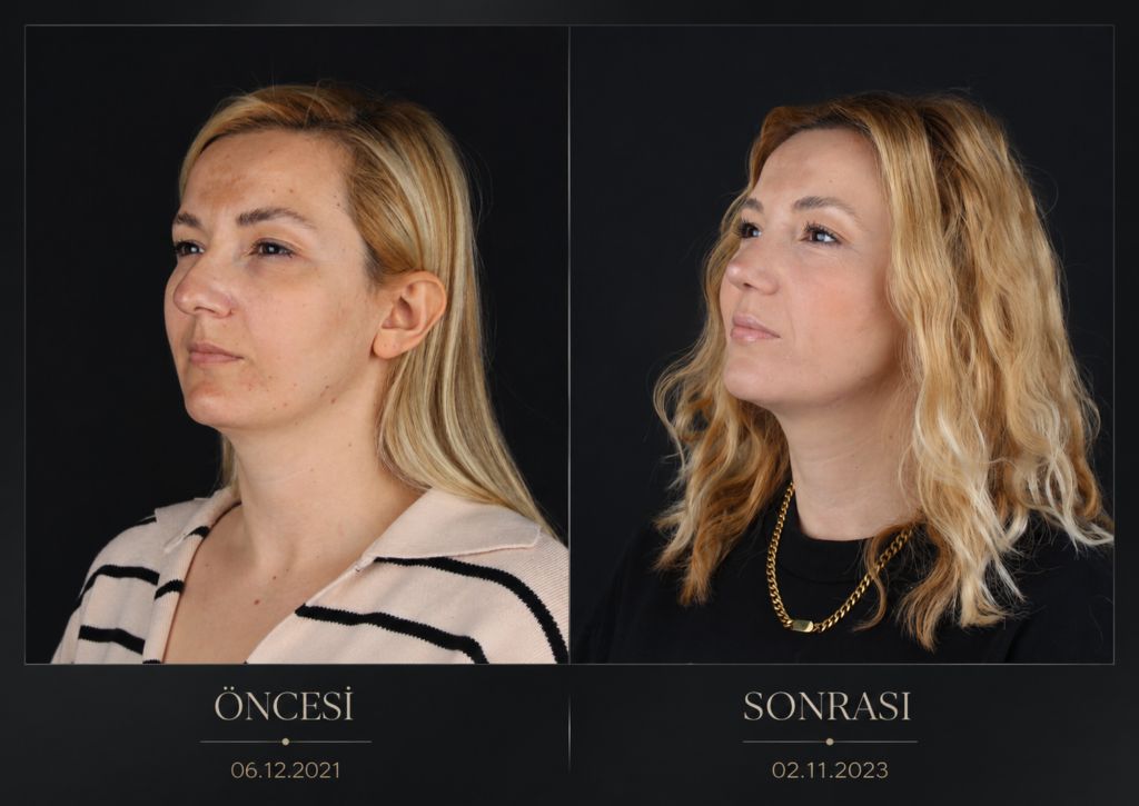 Öncesi / Sonrası 10