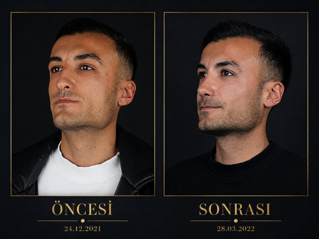 Öncesi / Sonrası 2
