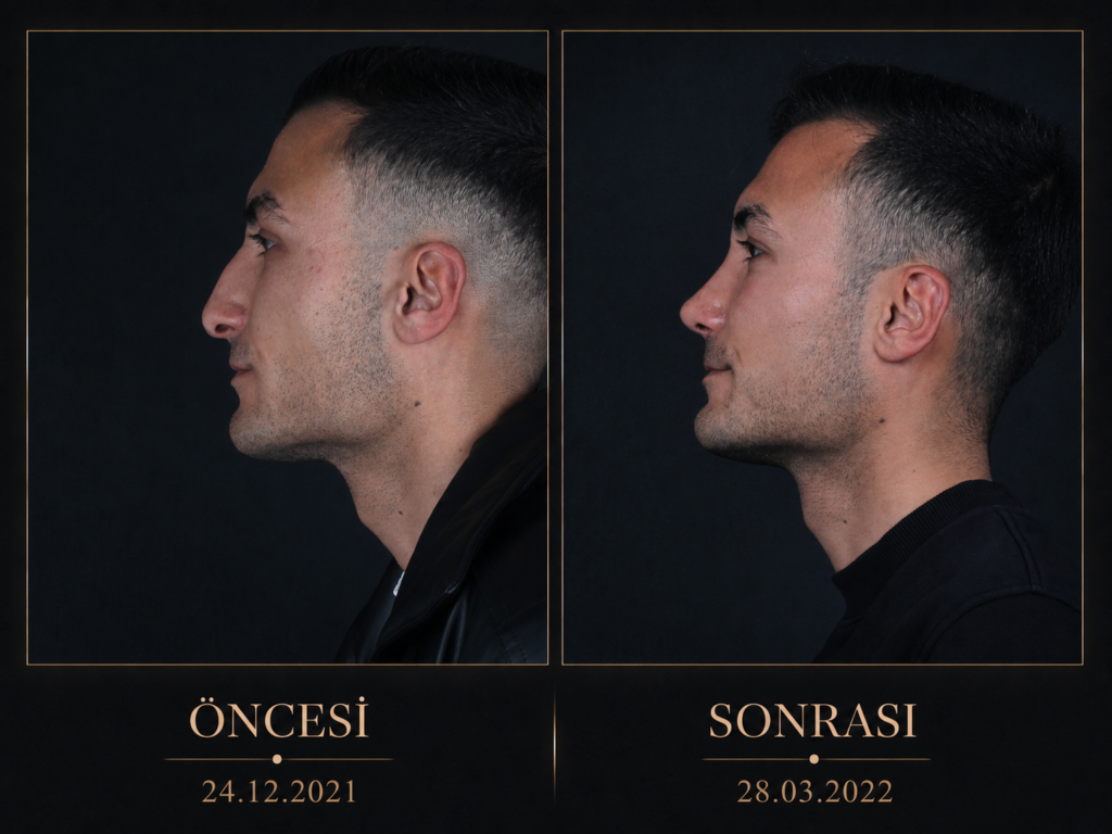 Öncesi / Sonrası 3