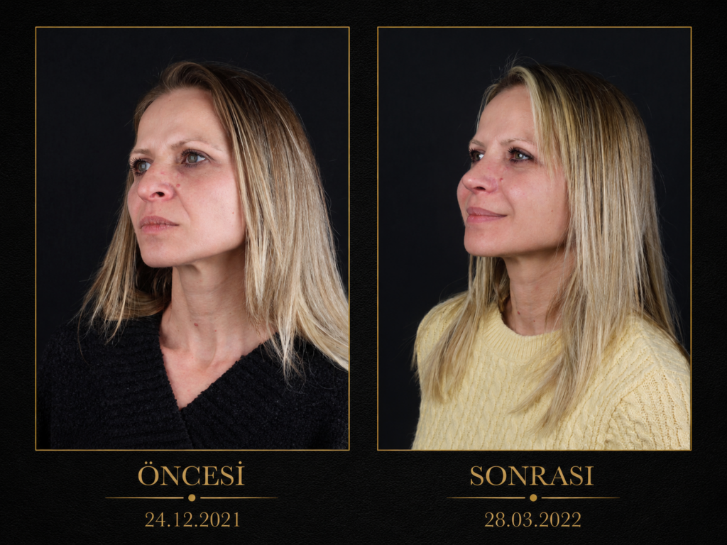 Öncesi / Sonrası 4