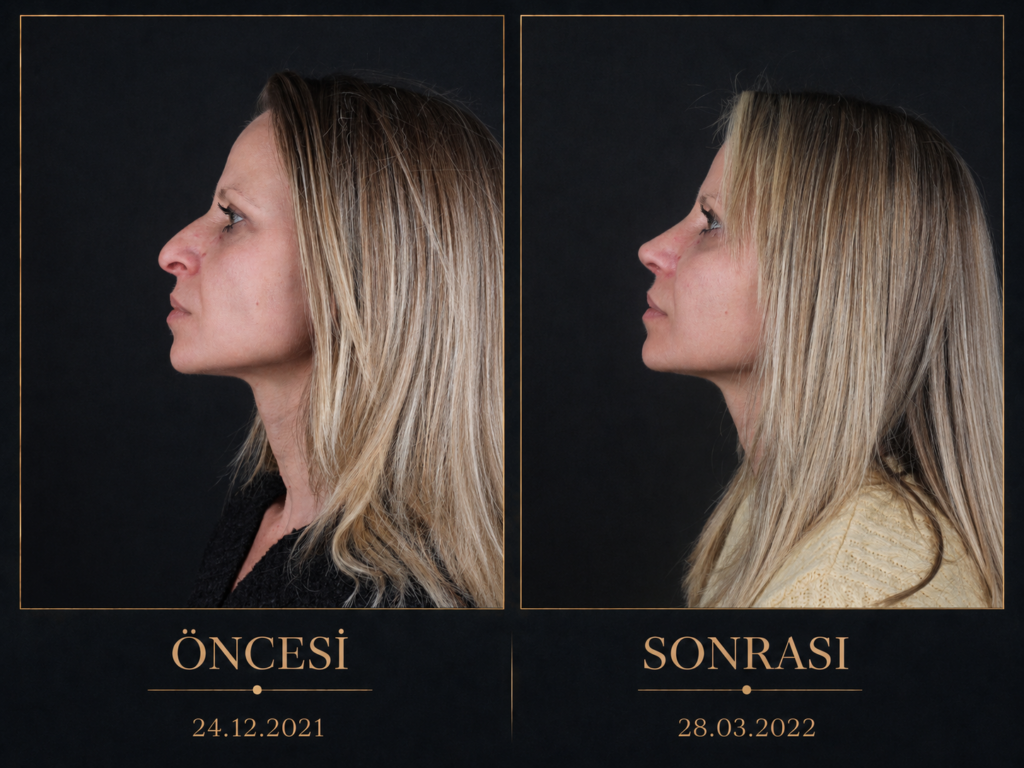 Öncesi / Sonrası 5